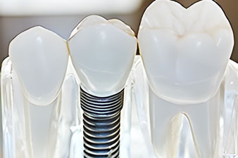 Dental Implants