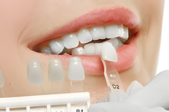 Dental Veneers and Dental Laminates